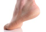 Fast Fixes for Heel Cracks that Work
